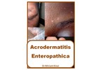 Thumbnail Acrodermatitis Enteropathica Thumbnail Acrodermatitis Enteropathica