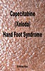 Thumbnail Capecitabine (Xeloda) Hand Foot Syndrome