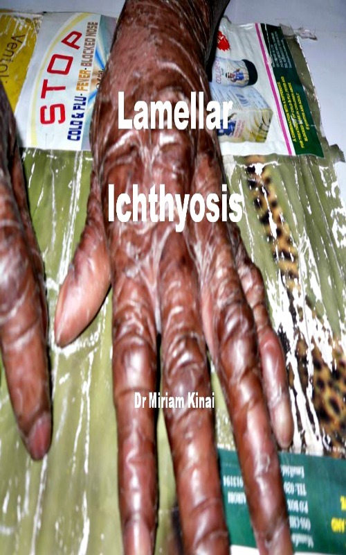 Product picture Lamellar Ichthyosis